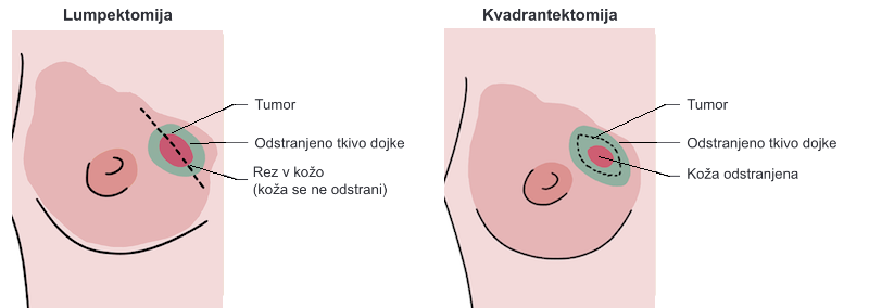 Ohranitvena operacija